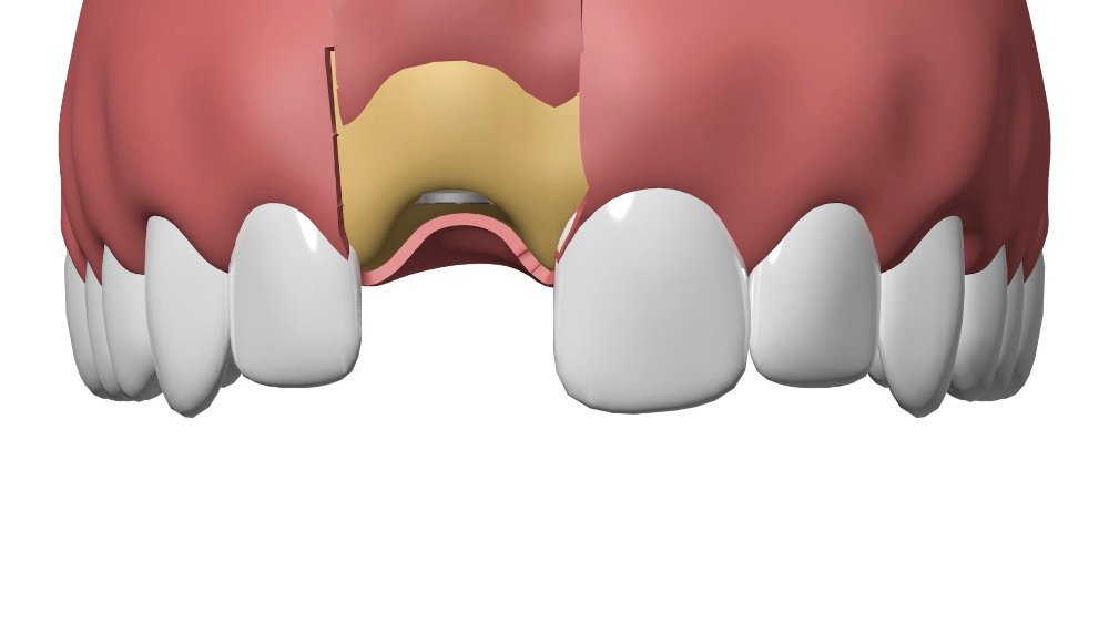 Cabinet dentaire Nimes Implant dentaire
